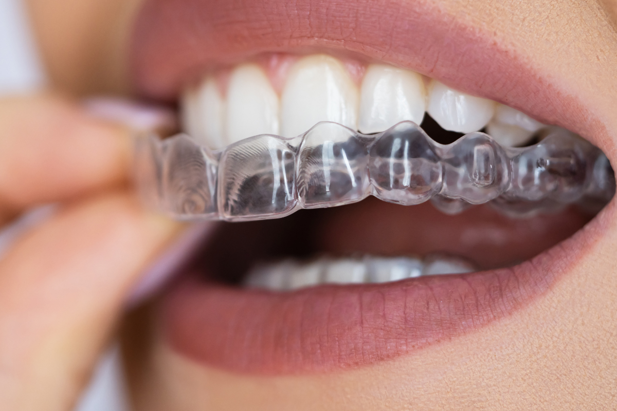 Invisible Aligners