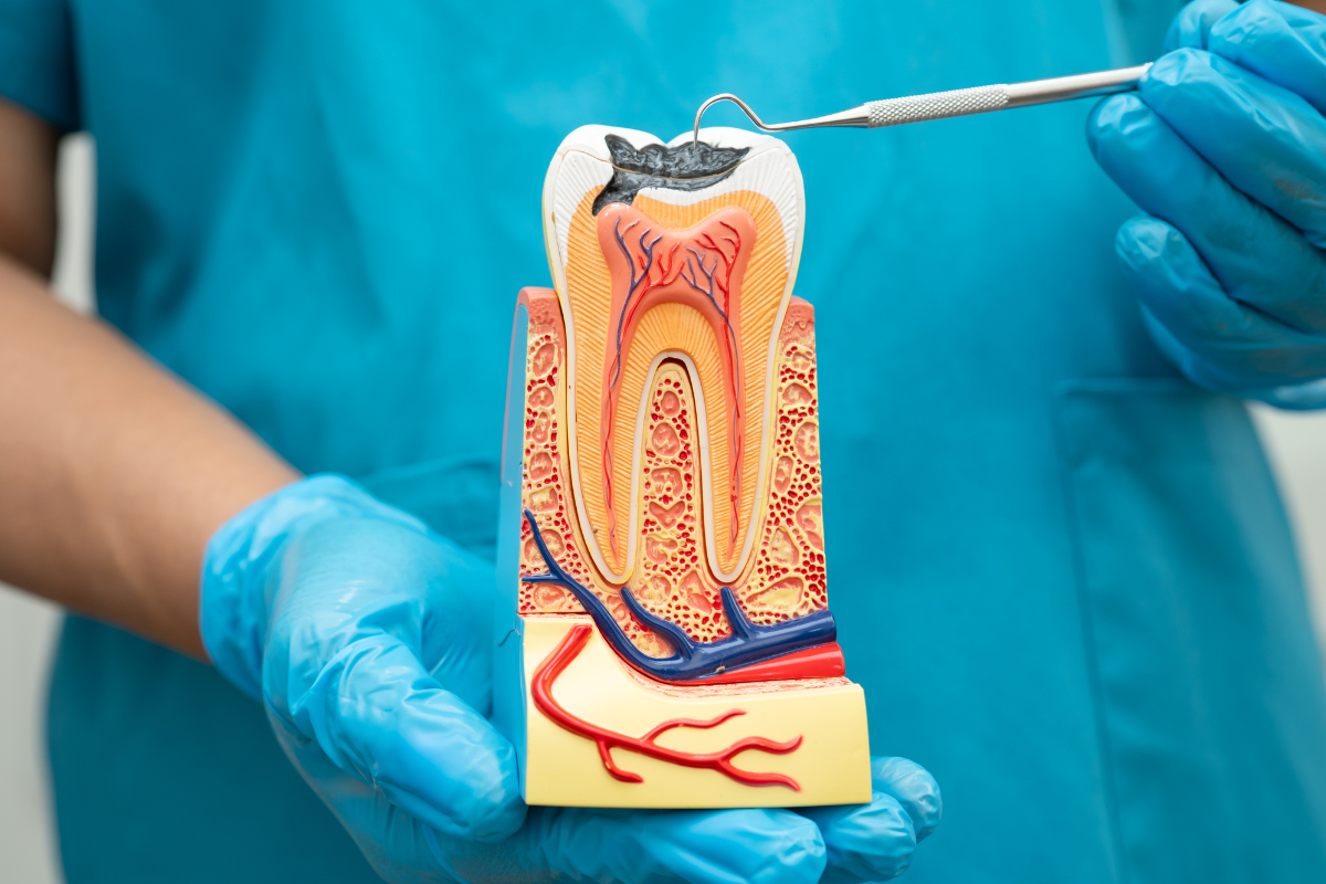 Root Canal Treatment
