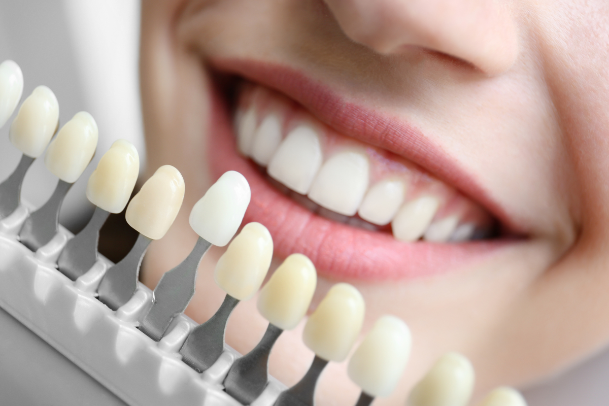Teeth Whitening